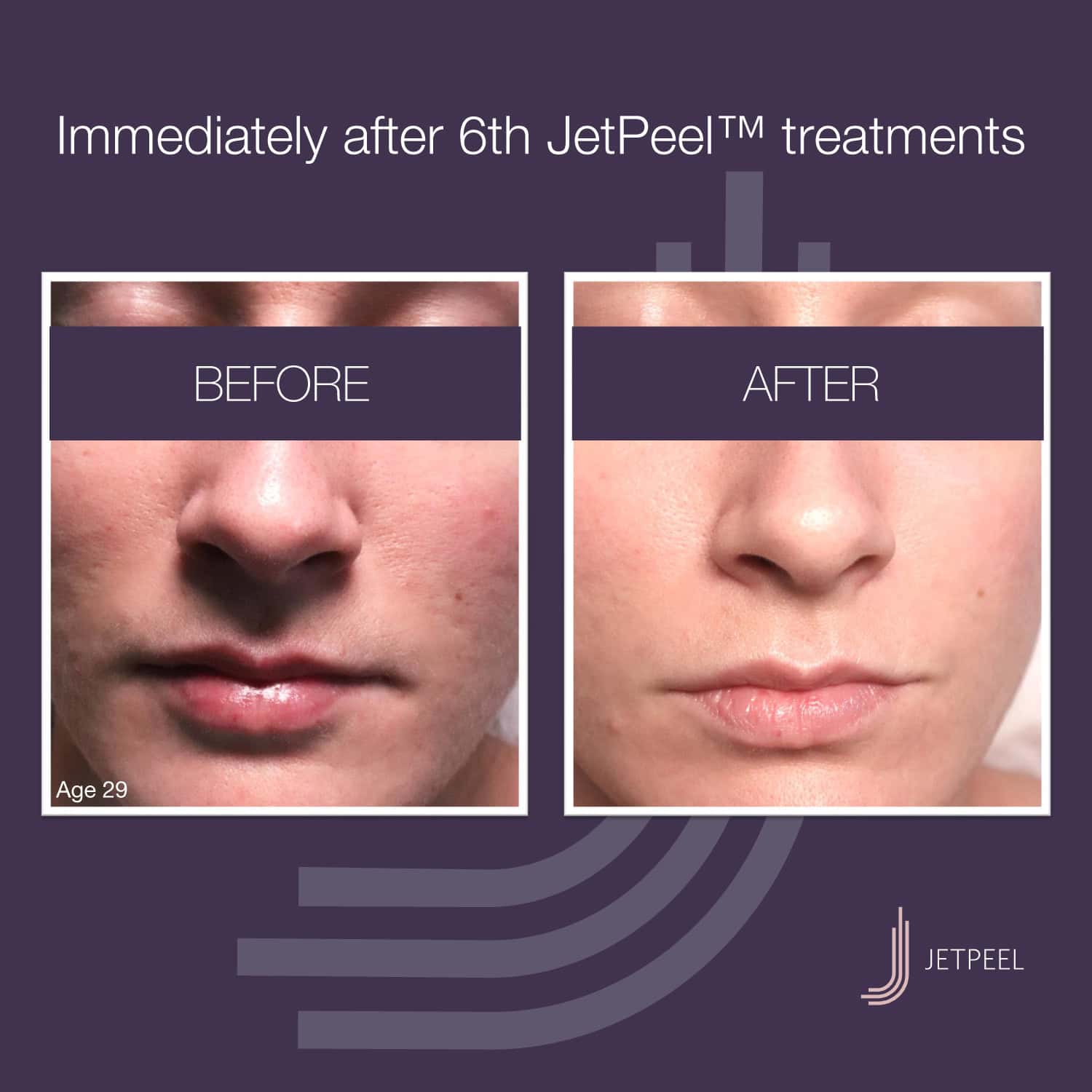Landsberg-JetPeel-Before-After-Image-ACNE-01