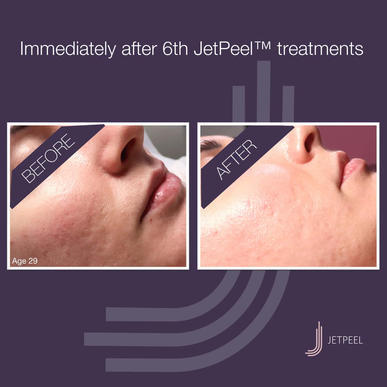Landsberg-JetPeel-Before-After-Image-ACNE-02