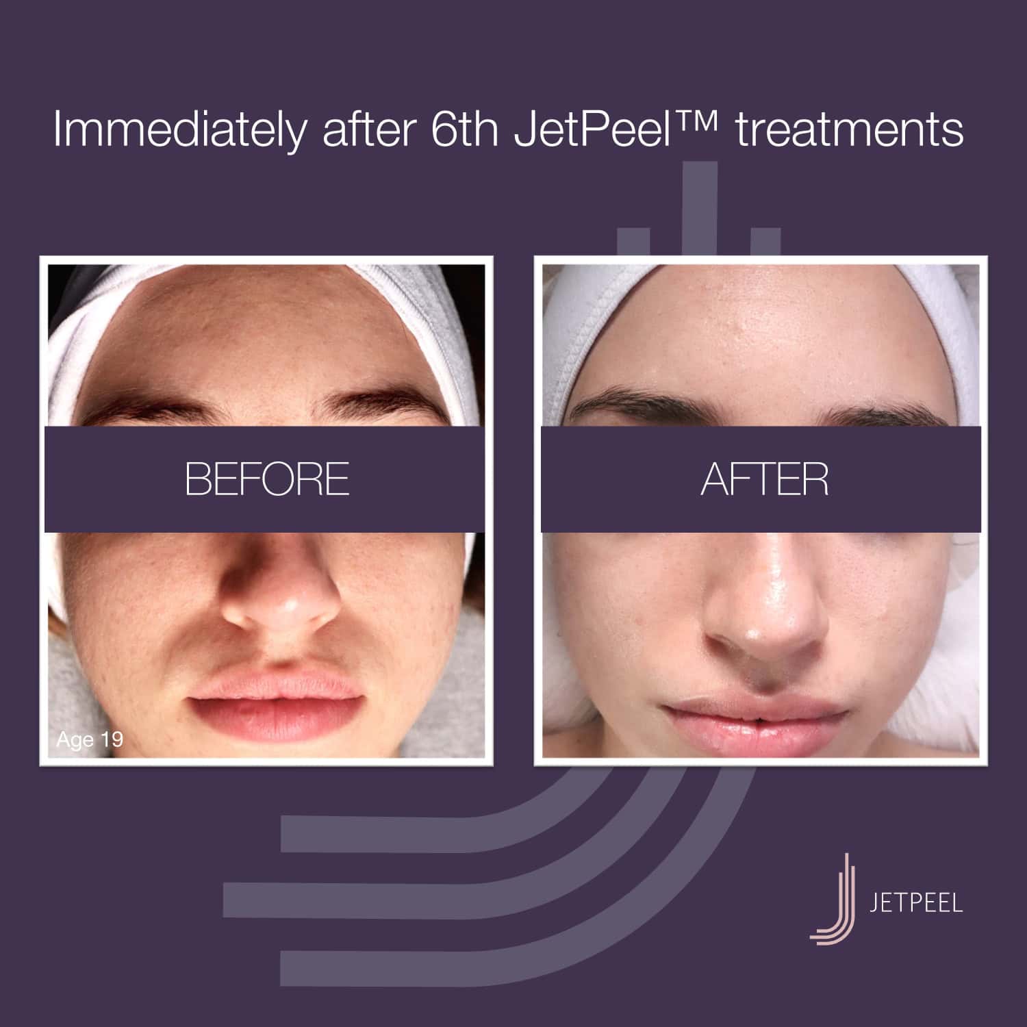 Landsberg-JetPeel-Before-After-Image-ACNE-03