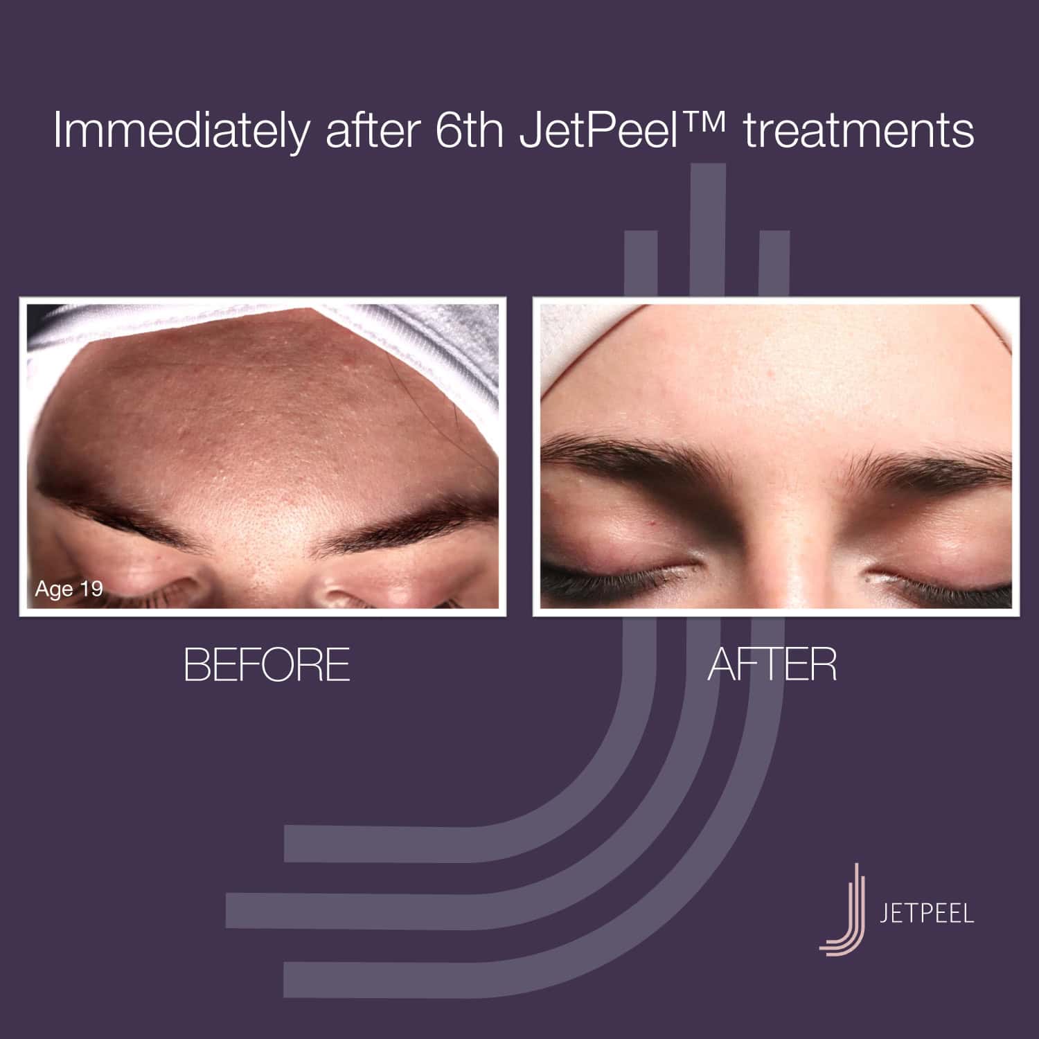 Landsberg-JetPeel-Before-After-Image-ACNE-04